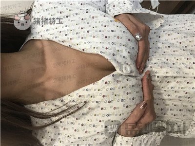 南京美贝尔,黄名斗,隆胸,案例,价格,