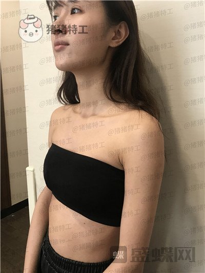 南京美贝尔,黄名斗,隆胸,案例,价格,