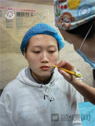长沙晶肤,朱苗,注射瘦脸,案例,价格,