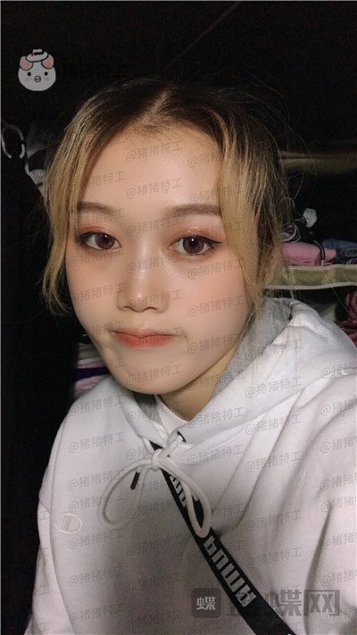 长沙晶肤,朱苗,注射瘦脸,案例,价格,