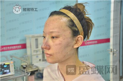 武汉希思特,陈安云,鼻部手术,案例,价格,