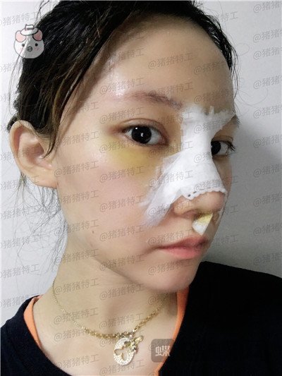 武汉希思特,陈安云,鼻部手术,案例,价格,