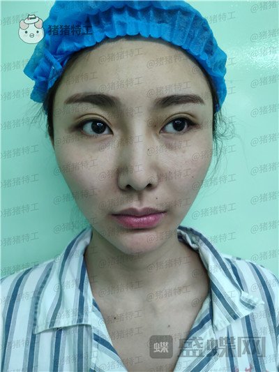 深圳恒生,肖添有,颧骨整形,案例,价格,