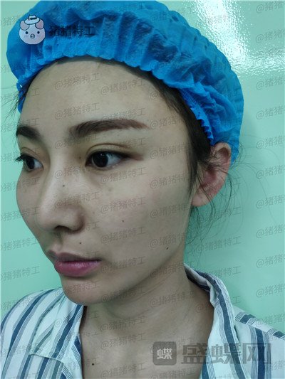 深圳恒生,肖添有,颧骨整形,案例,价格,