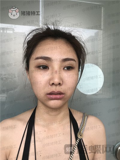 深圳恒生,肖添有,颧骨整形,案例,价格,