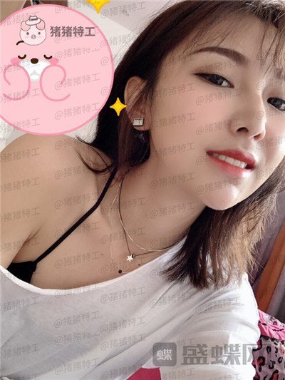 深圳恒生,肖添有,颧骨整形,案例,价格,