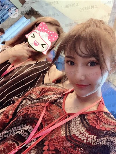 深圳恒生,肖添有,颧骨整形,案例,价格,