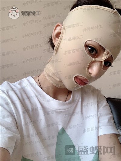 深圳恒生,肖添有,颧骨整形,案例,价格,