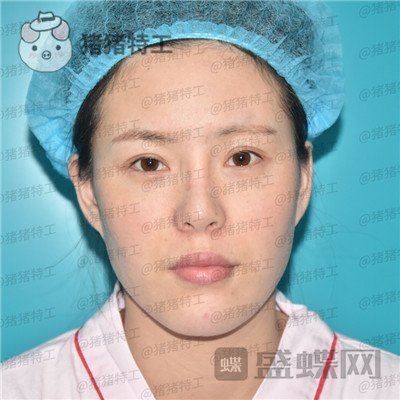 重庆百达丽,黄伟光,面部填充,案例,价格,