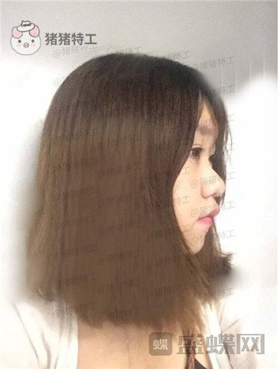 重庆玺悦台,蒋福明,面部吸脂,案例,价格,
