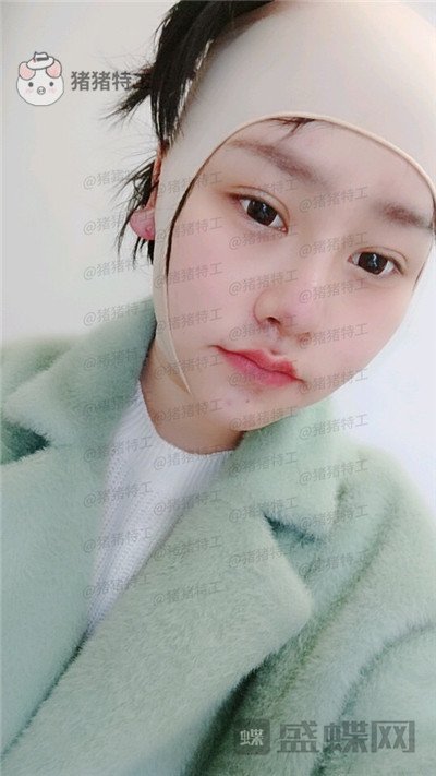 重庆玺悦台,蒋福明,面部吸脂,案例,价格,