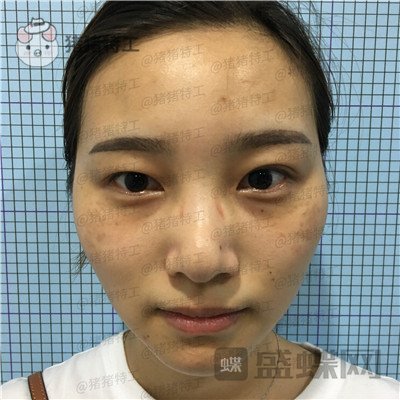 杭州格莱美,王馨婉,双眼皮,案例,价格,
