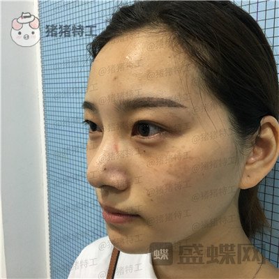 杭州格莱美,王馨婉,双眼皮,案例,价格,