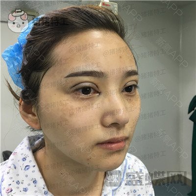 杭州格莱美,王馨婉,双眼皮,案例,价格,