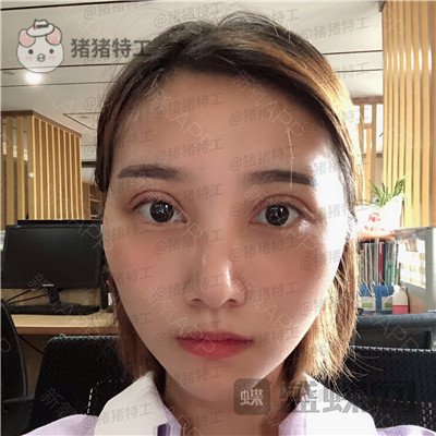 杭州格莱美,王馨婉,双眼皮,案例,价格,