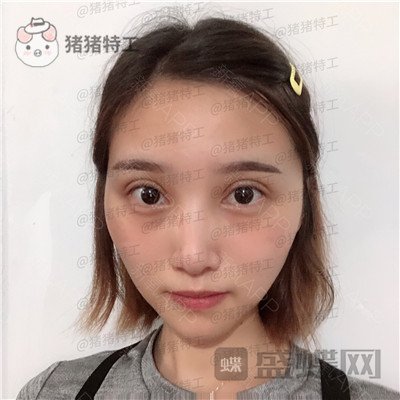 杭州格莱美,王馨婉,双眼皮,案例,价格,
