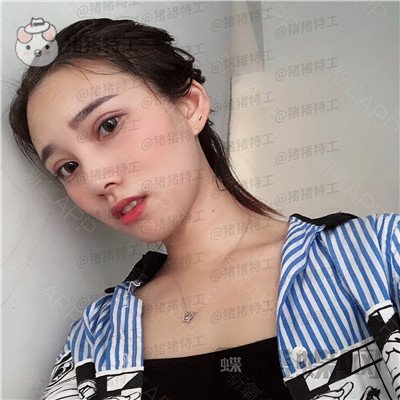 杭州格莱美,王馨婉,双眼皮,案例,价格,