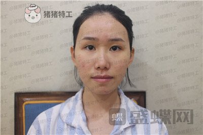 陕西韩媚,王仁根,面部填充,案例,价格,