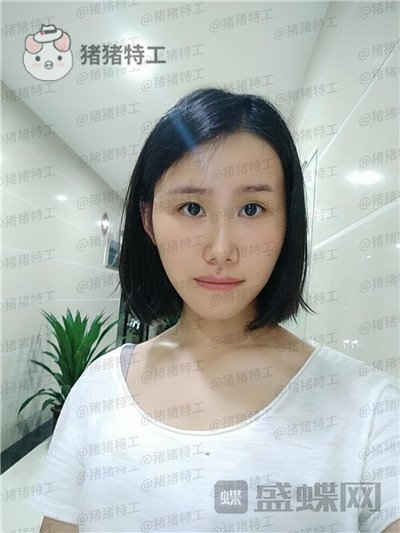 陕西韩媚,王仁根,面部填充,案例,价格,