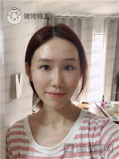 陕西韩媚,王仁根,面部填充,案例,价格,