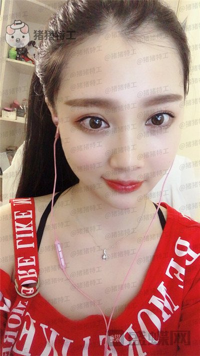 四川友谊,张立天,颧骨整形,案例,价格,