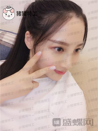 四川友谊,张立天,颧骨整形,案例,价格,