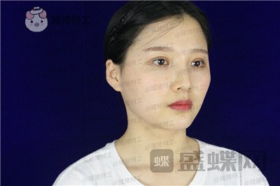 四川友谊,张立天,颧骨整形,案例,价格,