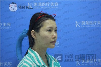 长沙凯莱,肖立卫,面部吸脂,案例,价格,