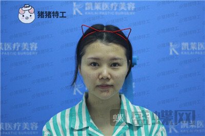 长沙凯莱,肖立卫,面部吸脂,案例,价格,