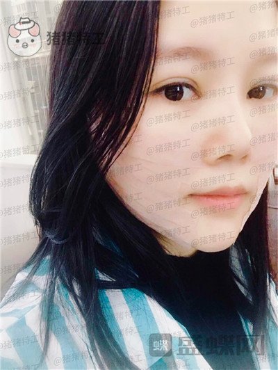 长沙凯莱,肖立卫,面部吸脂,案例,价格,
