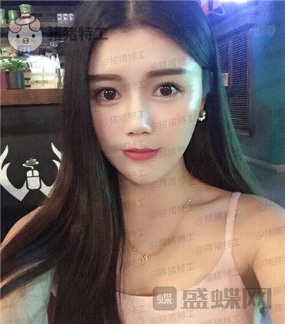 长沙凯莱,肖立卫,面部吸脂,案例,价格,