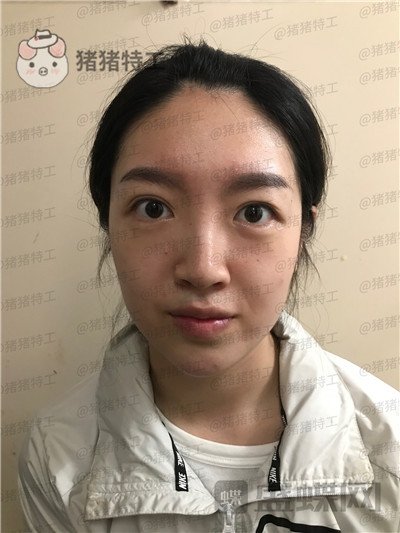 上海愉悦美联臣,陈红梅,面部填充,案例,价格,