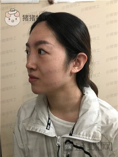 上海愉悦美联臣,陈红梅,面部填充,案例,价格,