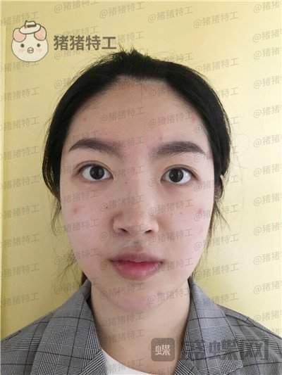 上海愉悦美联臣,陈红梅,面部填充,案例,价格,