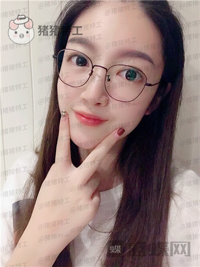 上海愉悦美联臣,陈红梅,面部填充,案例,价格,