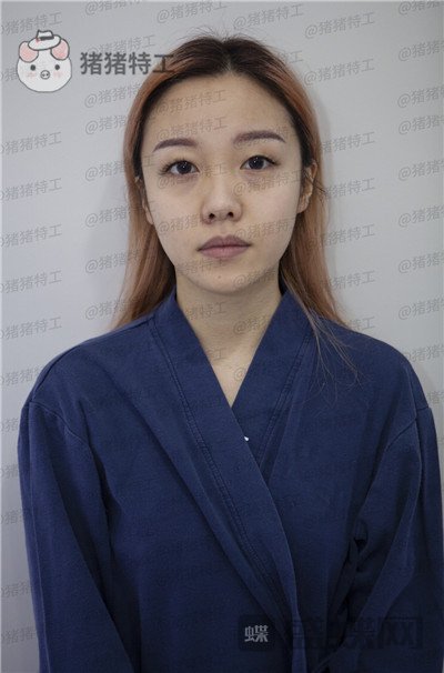 重庆铂生,郝荣涛,双眼皮,案例,价格,