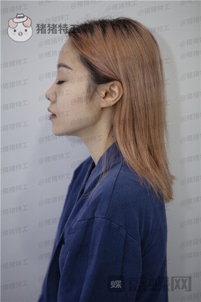 重庆铂生,郝荣涛,双眼皮,案例,价格,