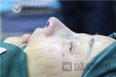 北京长虹,于志宏,隆鼻,案例,价格,
