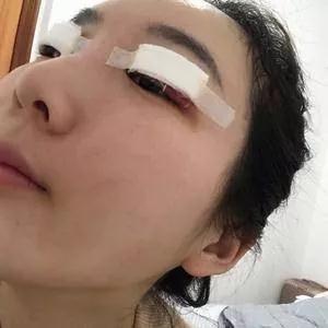成都中医大银海何军眼部手术怎么样?