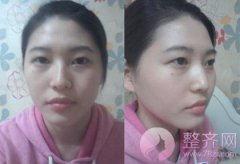 自体脂肪填充案例分享