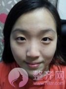 双眼皮和案例分享