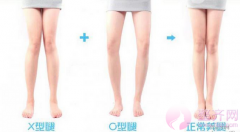  北京华意整形李沁奕O型腿矫正怎么样？