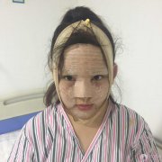 自体脂肪填充和隆鼻术后半个月