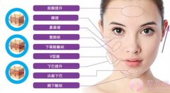 什么是悬吊抗衰术？