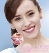 3分钟解析牙套上“钢丝”的力量究竟有多神