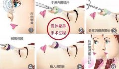 【假体隆鼻注意事项】