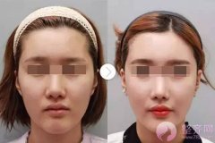 隆鼻有哪些好处？