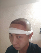 上海王先生头发种植案例分享
