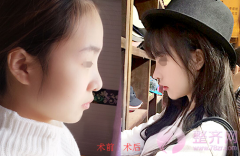 武汉假体隆鼻术后180天案例