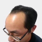 武汉仁爱王海峰种植发际线怎么样？好不好？案例分享2